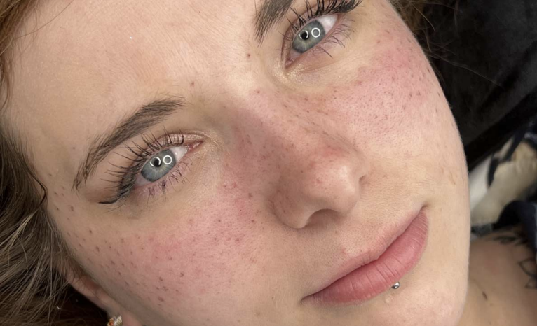 Formation taches de rousseur & grain de beauté – Dermopigmentation (Antibes & en ligne)Nouveau cours